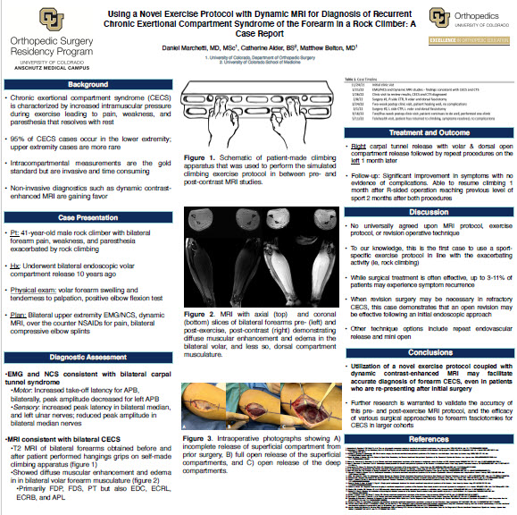 Using a Novel Exercise Protocol with Dynamic MRI for Diagnosis of Recurrent Chronic Exertional Compartment Syndrome of the Forearm in a Rock Climber: A Case Report