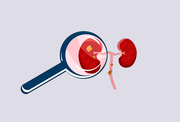 chronic-kidney-disease
